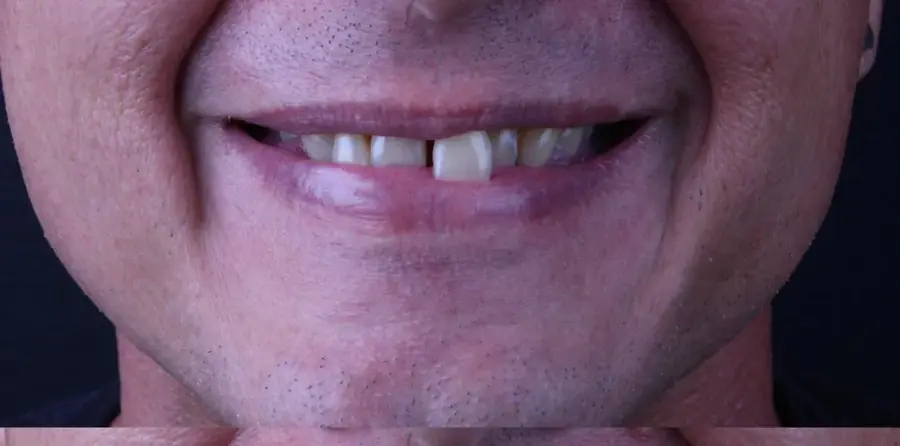 Antes: sorriso de paciente com lentes de contato dental