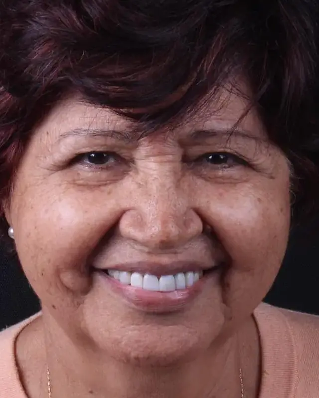 Depois: sorriso de paciente após repor o dente da frente
